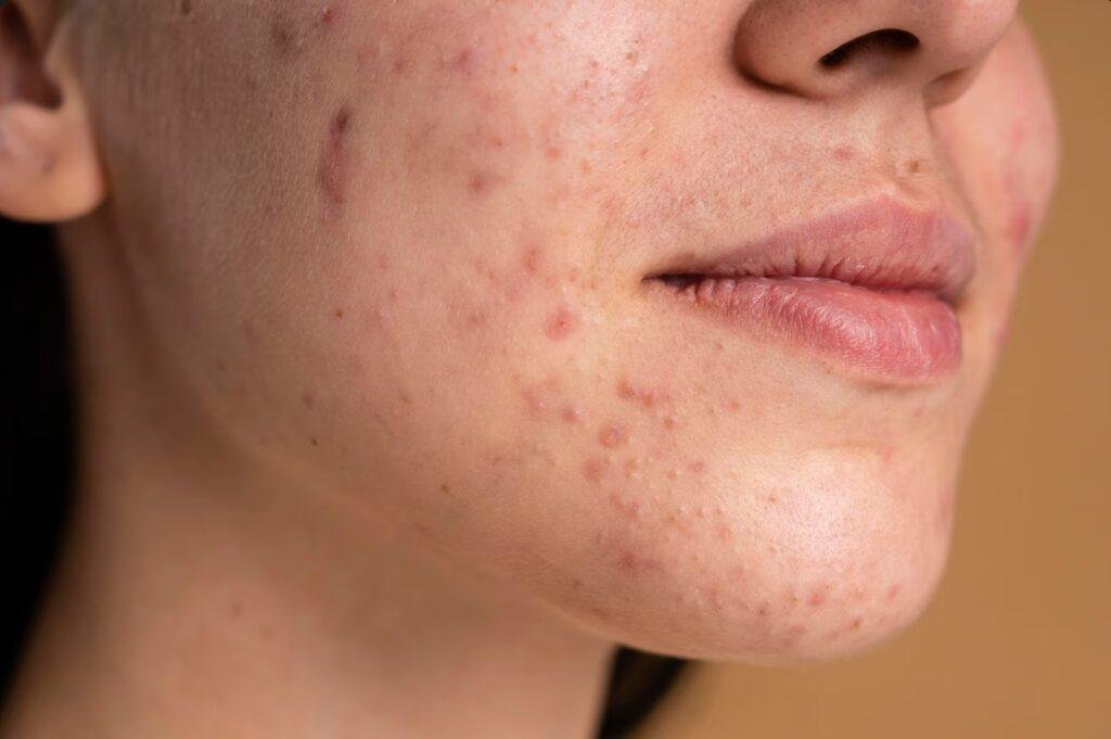 Acne: Causes, Types, Symptoms, and Effective Treatment Options